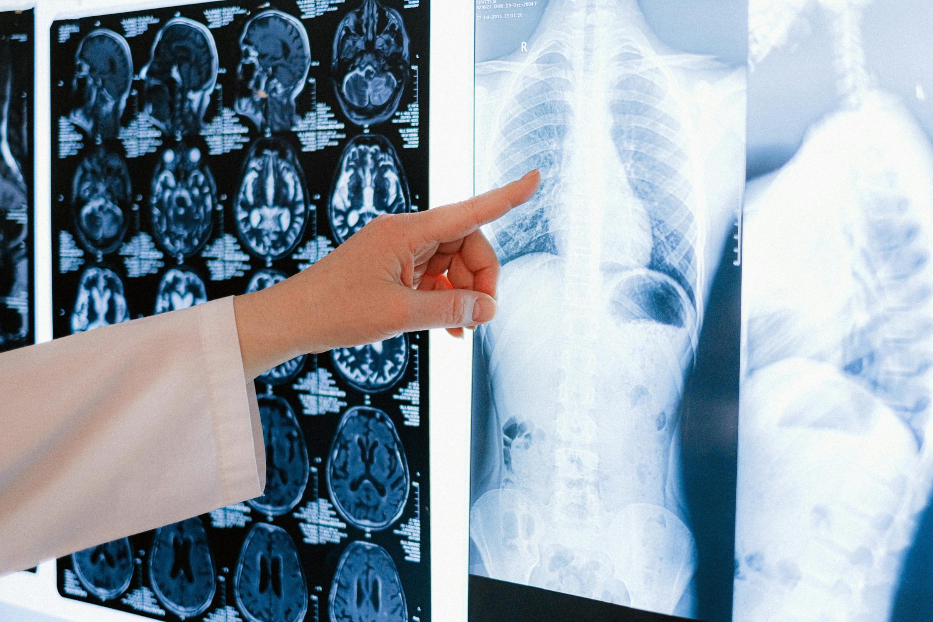 A radiologist pointing at a chest X-ray on a lightbox, brain scans on the film beside it